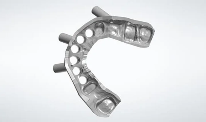 Close-up of an implant surgical guide