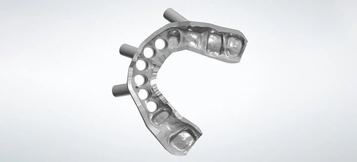 Nahaufnahme einer Implantat-Bohrschablone