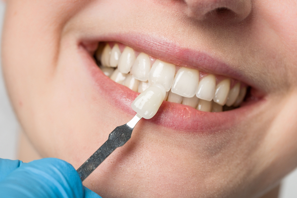 Entdecken Sie, wie unsere Dentalprofis durch genauen Farbvergleich Veneers kreieren, die nahtlos zu Ihrem natürlichen Zahnton passen. 